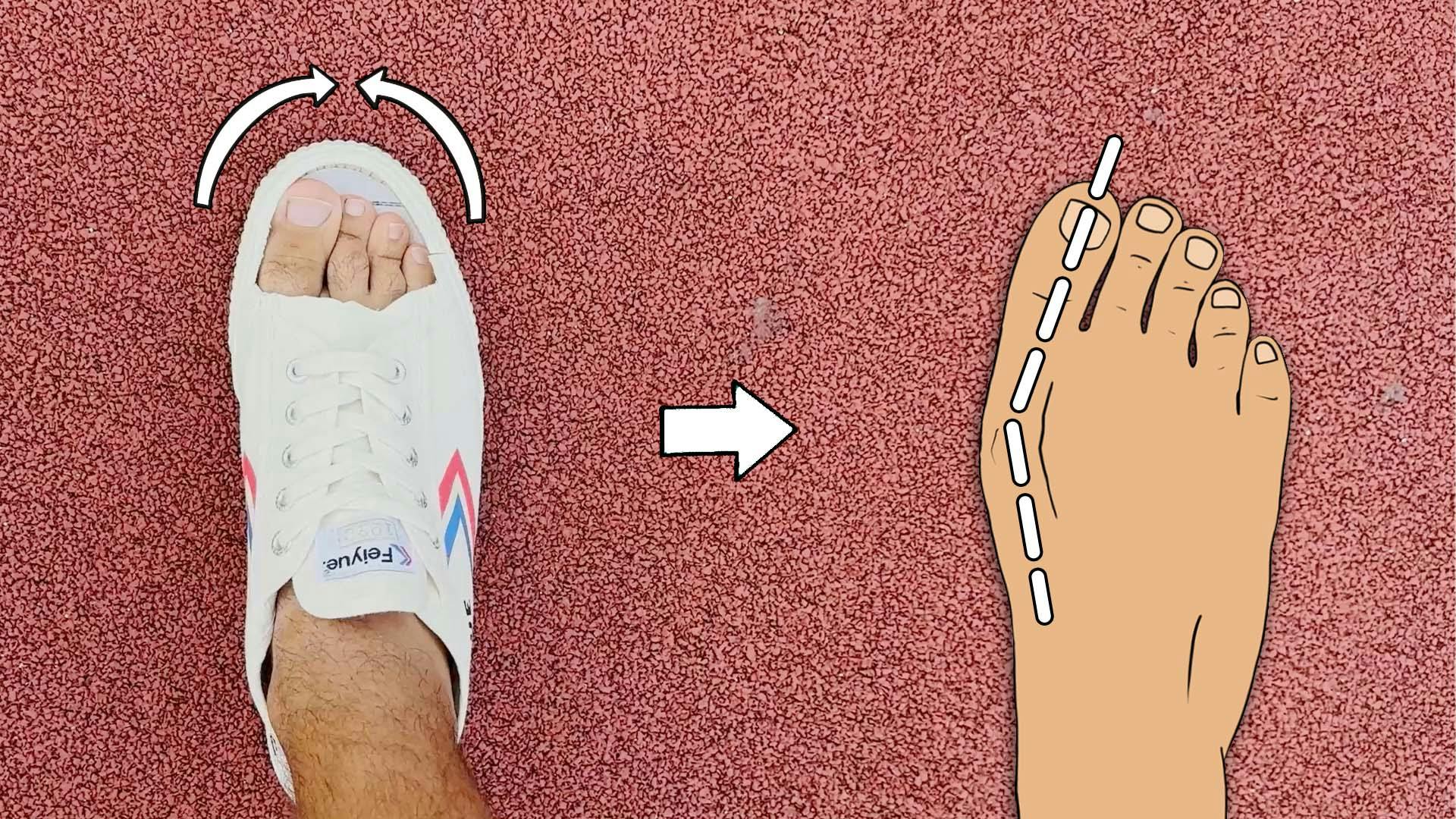Pointed Toe Box Shoes Pull the Toes out of Alignment (hallux Valgus)