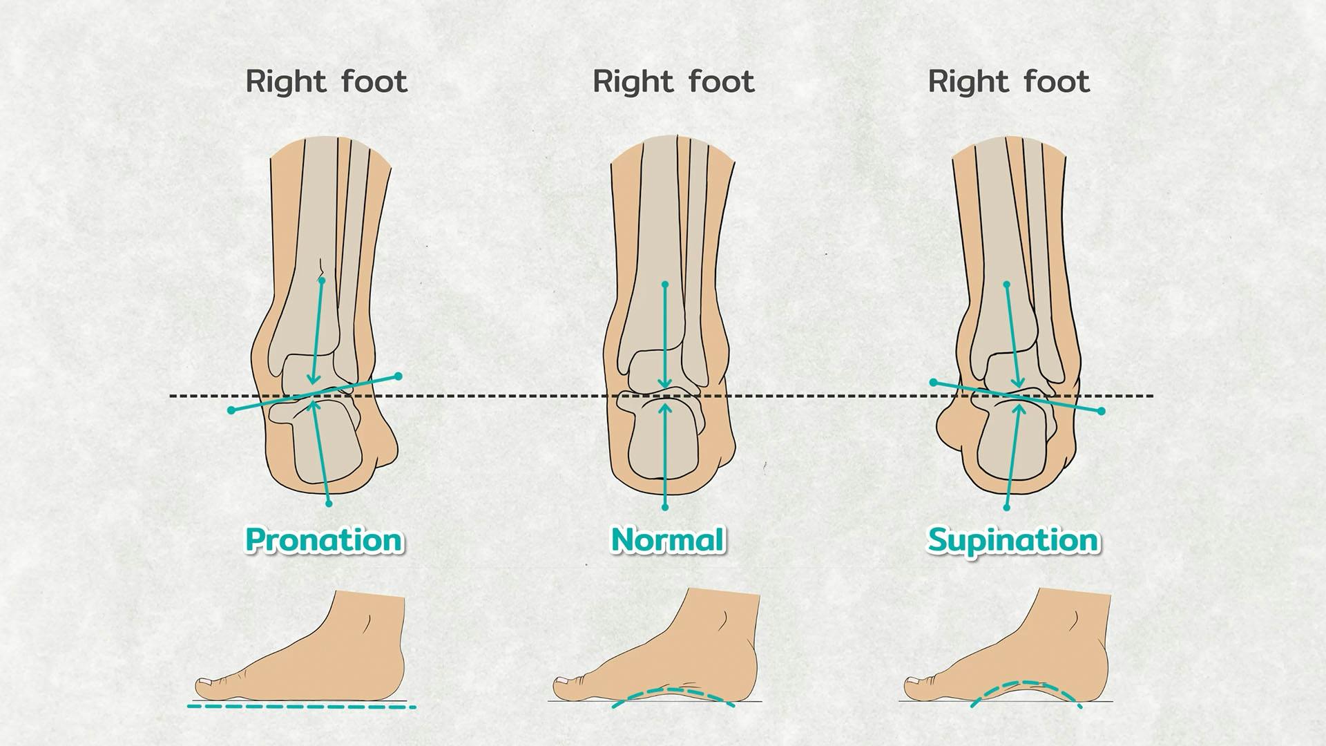 Pronated, Neutral and Supinated Foot