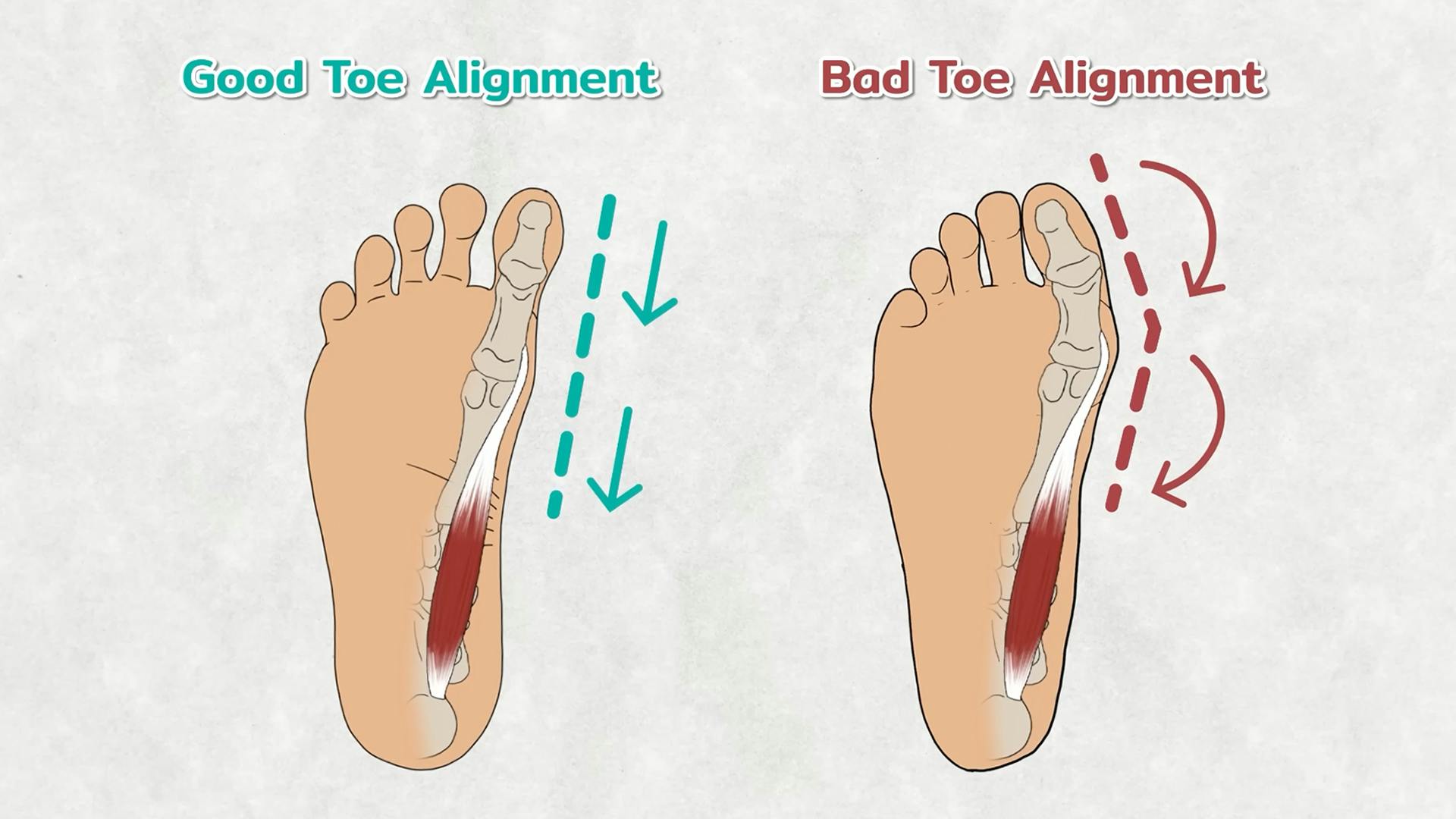 Good Vs Bad Toe Alignment