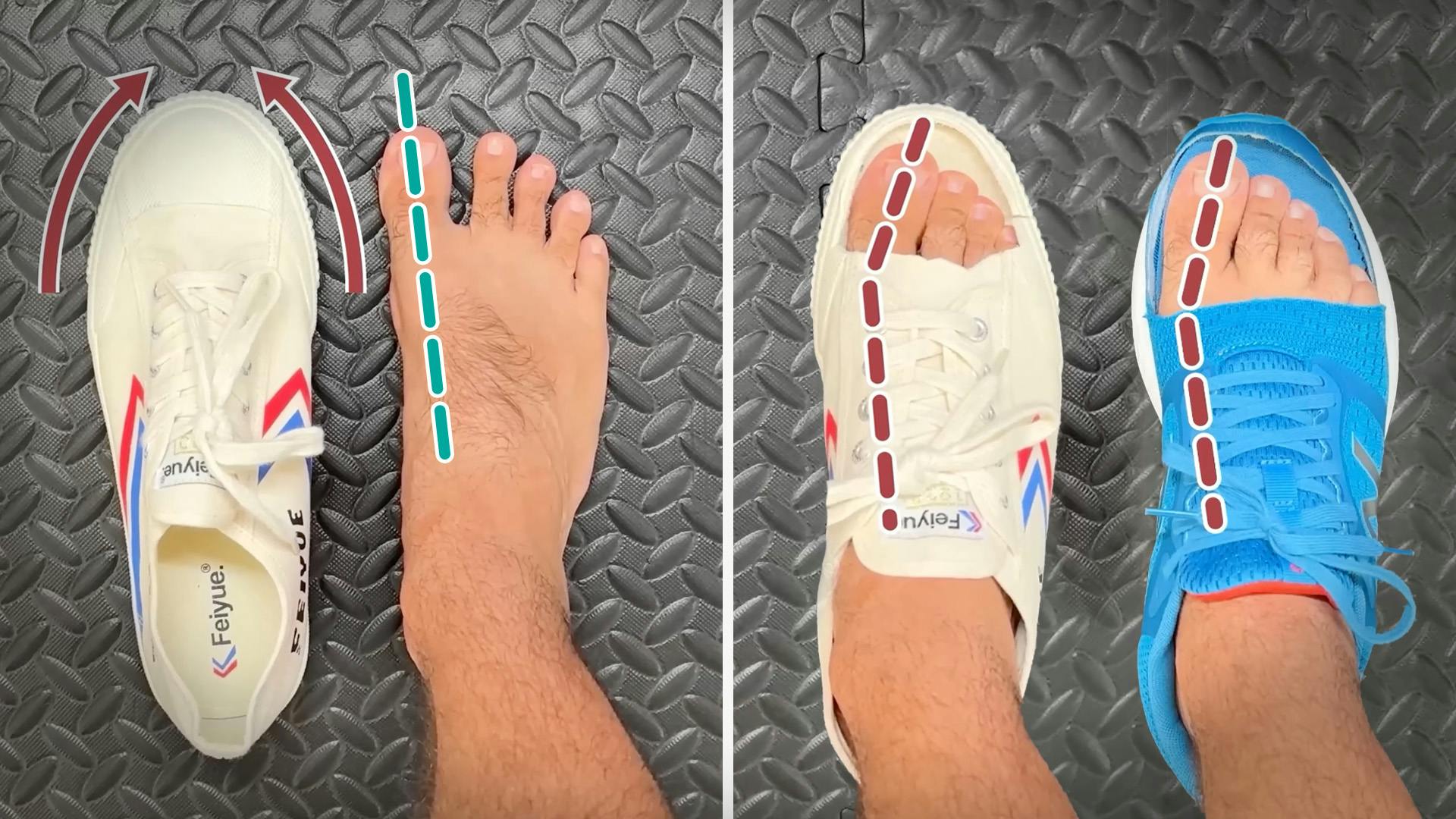 Toe Alignment in Shoes With Narrow Toe Box