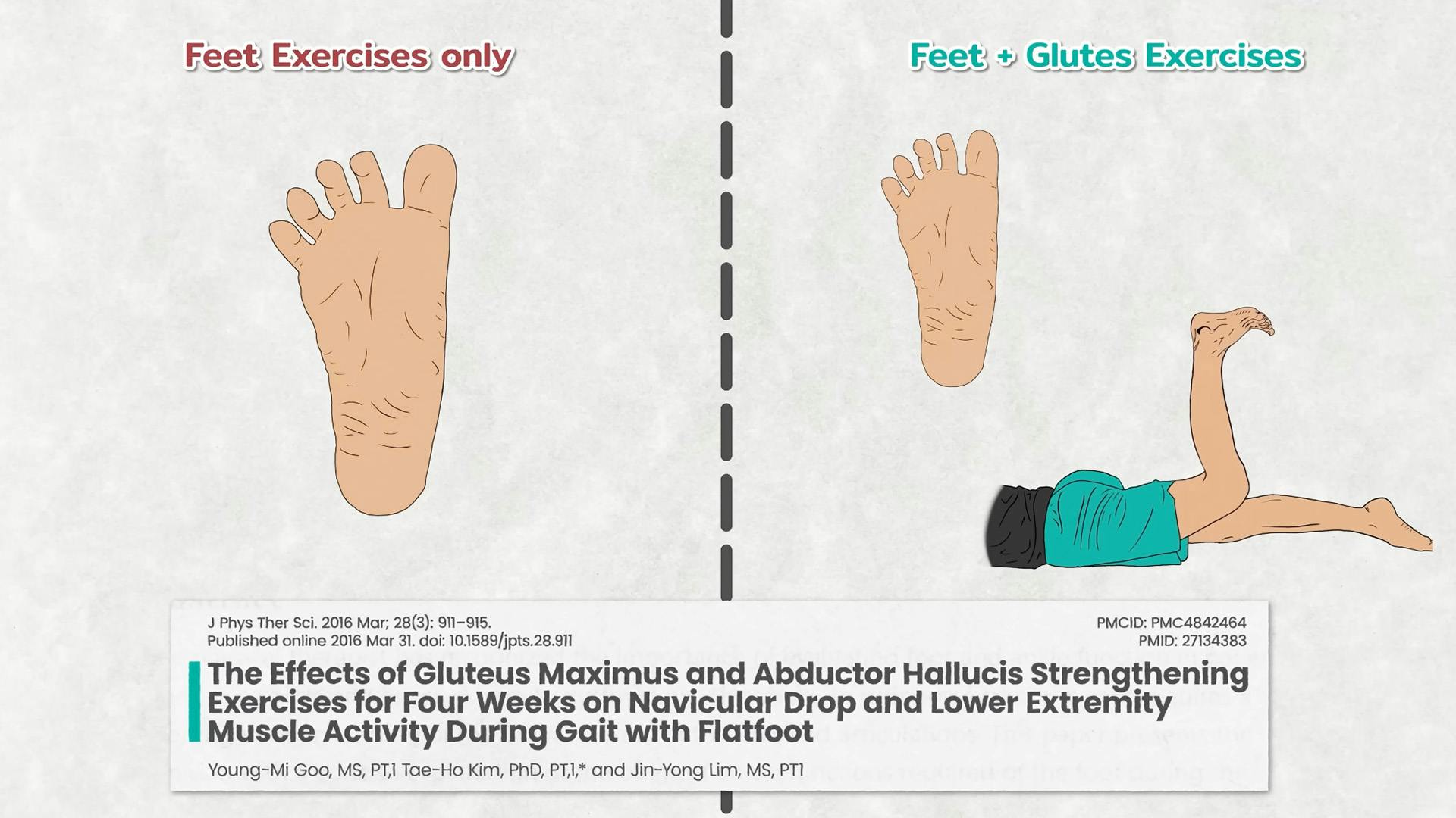 Foot and Glute Strengthening for fixing Flat Feet 